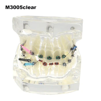 Zobozdravstveno Zdravljenje Ortodontija Model S Kovinskimi Nosilci Žice, Vezi, Verig Jasno